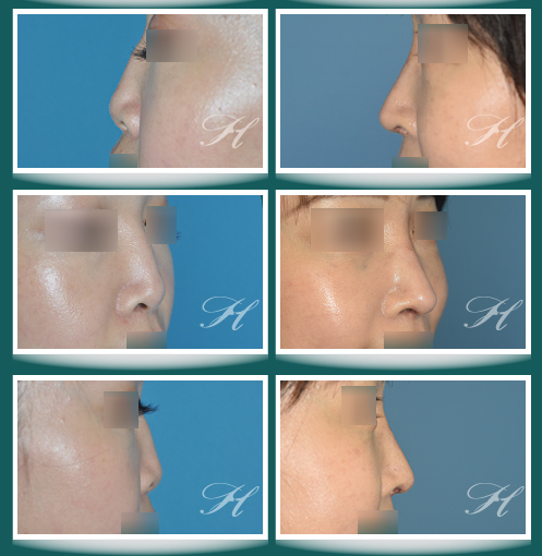 蕭彥彰醫師鼻整型(隆鼻)中心:: 醫學新知- 2023-11月份隆鼻鼻整形案例 